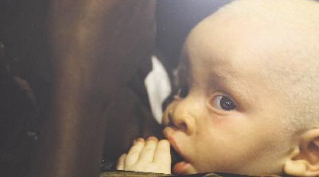 ‘Kara Kıtanın Beyaz Çocukları’: Afrikalı albinoların dramı sanatseverlerle buluştu