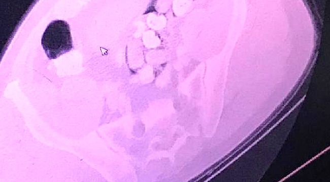 Yuttuğu 47 paket uyuşturucu hastanede çıkartıldı.