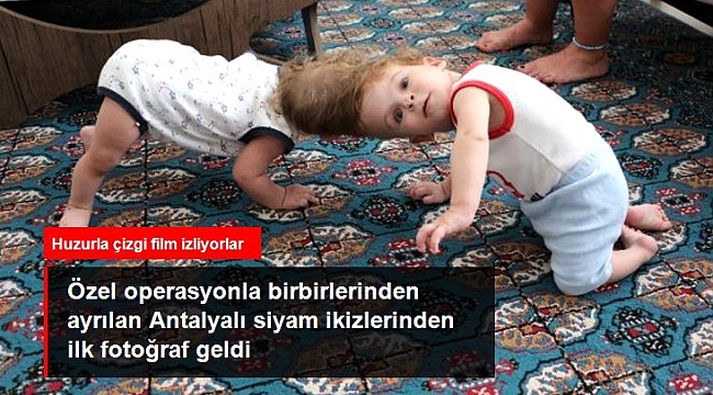 Özel operasyonla birbirlerinden ayrılan Antalyalı siyam ikizlerinden ilk fotoğraf geldi.
