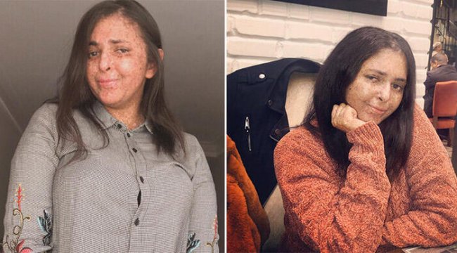 Nadir görülen hastalığı yüzünden 20 yıldır gün ışığına çıkmadı