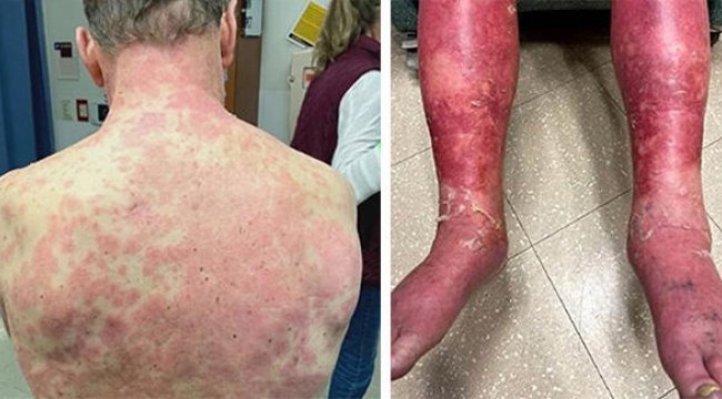 ABD'de Johnson&amp;Johnson aşını vurulan kişide