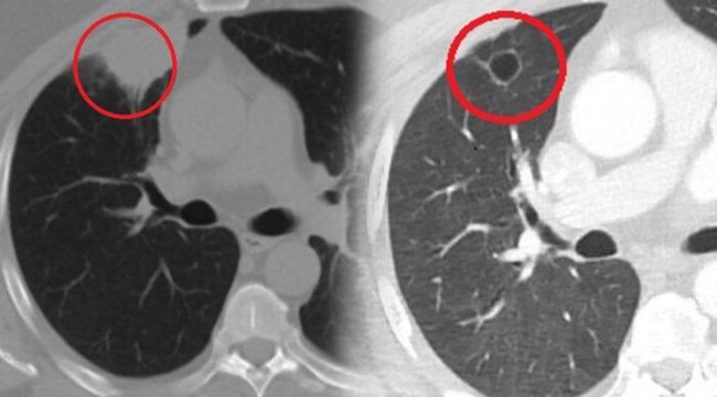 Dünya tıp literatüründe bir ilk! Koronavirüs akciğer kanserini taklit etti