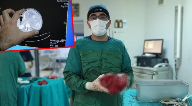 Ağrı şikayetiyle gitti gerçek çok farklı çıktı: 5,5 kiloluk böbrek tümörü çıkarıldı