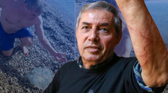 Profesörü denizanası çarptı! &#039;Dikkat! Sakın tatlı su dökmeyin&#039;