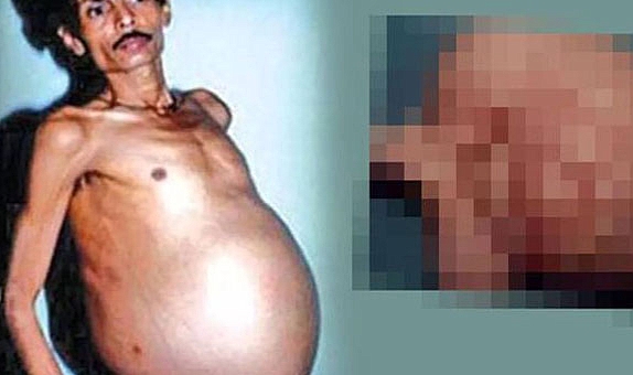 ‘Hamile adam’ vakası! Kanser sandılar bebek çıktı