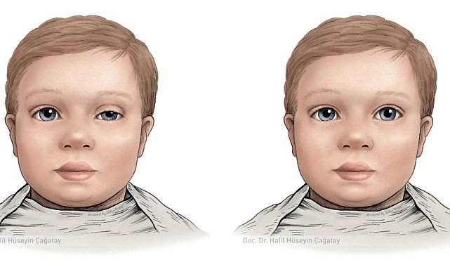 Bebeklerde göz kapağı düşüklüğü erken müdahaleyle onarılabilir