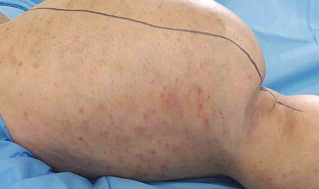 Ameliyatta kesilmekten kurtulan bacağından 6 kilo tümör çıkarıldı