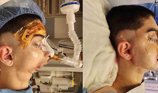Doğuştan alt çenesi olmayan çocuğa başarılı operasyon: 17 yıl sonra normal yemek yiyebilecek