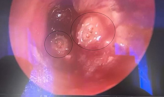 Bursa&#039;da çocuğun kulağından 2 kurtçuk çıkarıldı