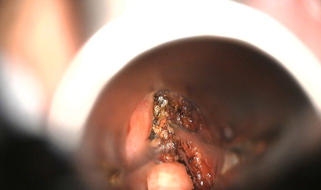 Gırtlak kanserinde boğazı delmeden lazerli tedavi imkanı