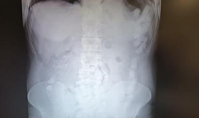 Midesinden 100 kapsül uyuşturucu çıktı