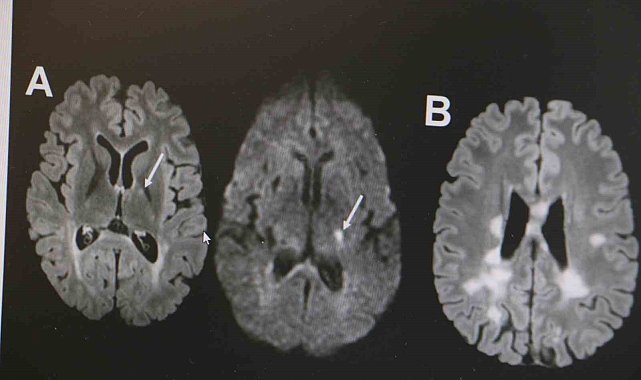 Nöroloji Uzmanı Dr. Demir: "MS hastalığında D vitamini oldukça önemlidir"