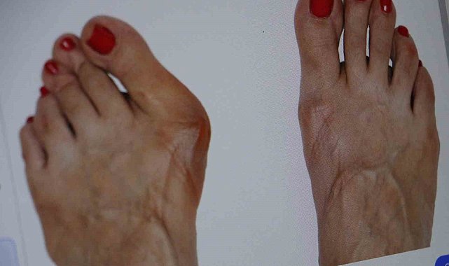 Topuklu ve sivri burun ayakkabı giyenler dikkat: Parmağınızın anatomisi bozulabilir