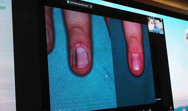 Cildiye profesörü uyardı: "Tırnak dibinde görülen siyah leke, cilt kanseri öncüsü olabilir"