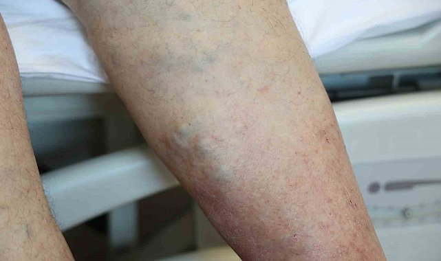 Sıcak kum ve şortlar varisi tetikliyor tetikliyor