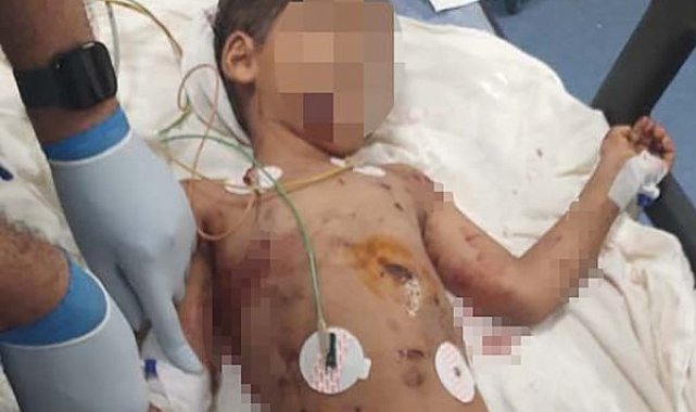 Sokak köpeklerinin saldırdığı 5 yaşındaki Abbas ağır yaralandı