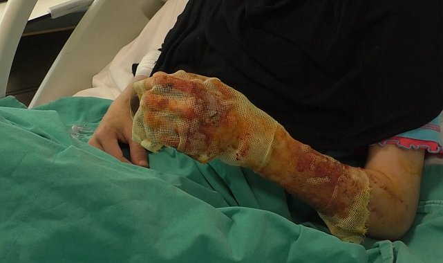Mangal ateşine dezenfektan döken çift dehşeti yaşadı: "Eşim ateşi harlamak istedi, lütfen acele etmeyin"