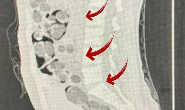 Uçakla giriş yapmış! Denizli'de yabancı uyruklu bir kişinin midesinden 219 paket uyuşturucu çıktı
